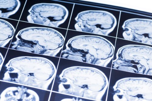 Traumatic Brain Injury Lawyer Durham